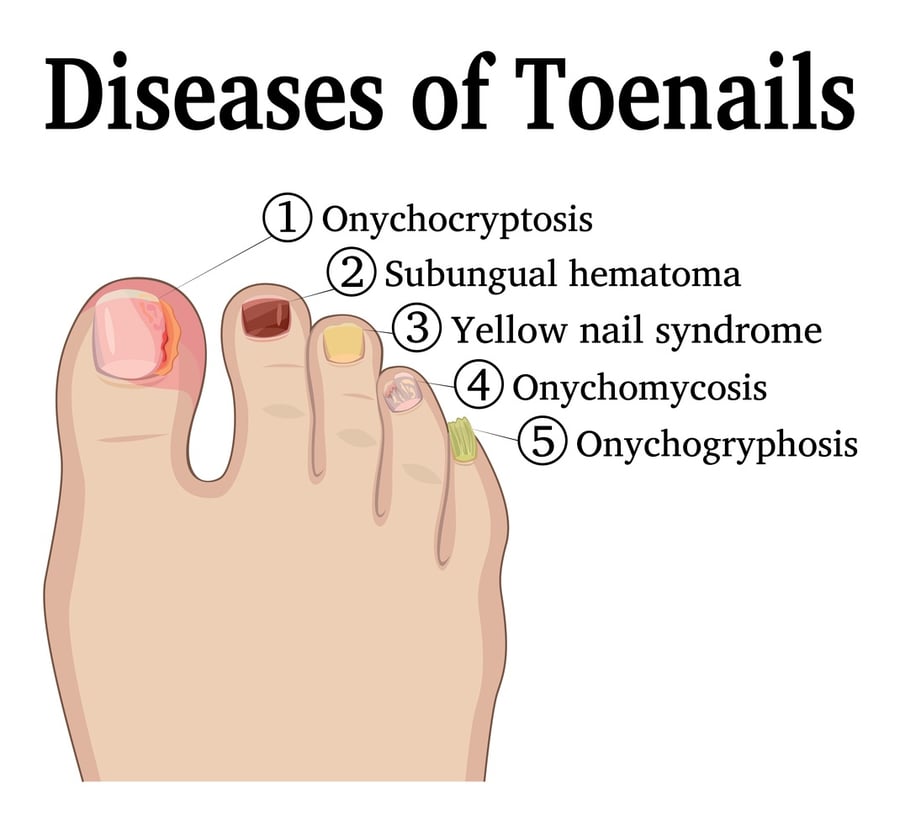 Toe Pain And Discolored toenails